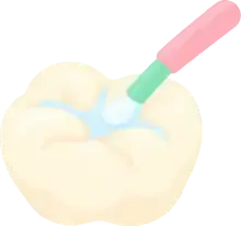 Sealant on a molar